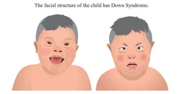 George Clooney's Twins And The Intriguing Aspects Of Down Syndrome