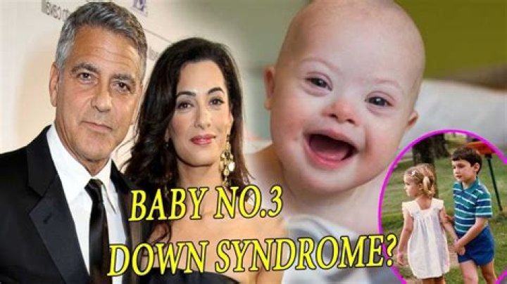 Unveiling The Clooney Twins' Down Syndrome: Insights And Discoveries