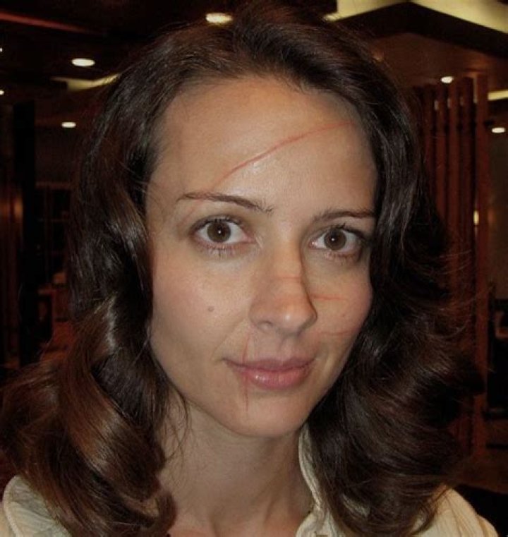 Unveiling The Journey Of Healing And Resilience: Jessica Dube's Facial Injury