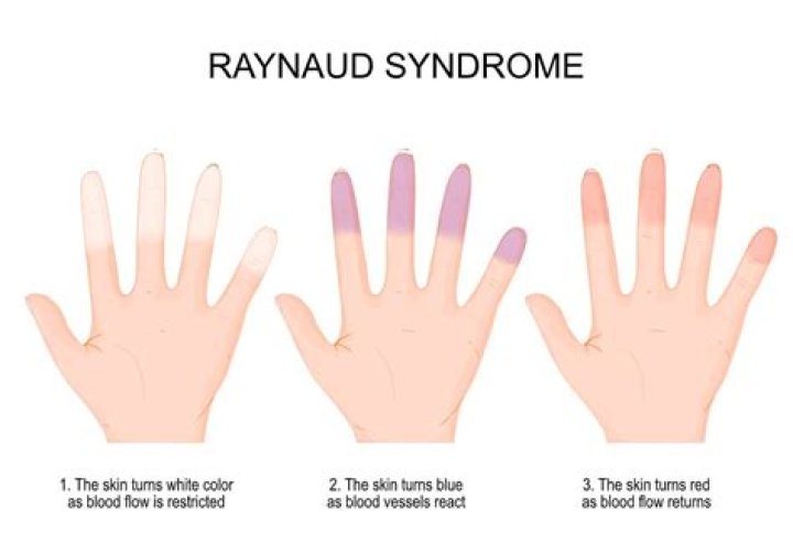 Unveiling The Mysteries Of Raynaud's Phenomenon