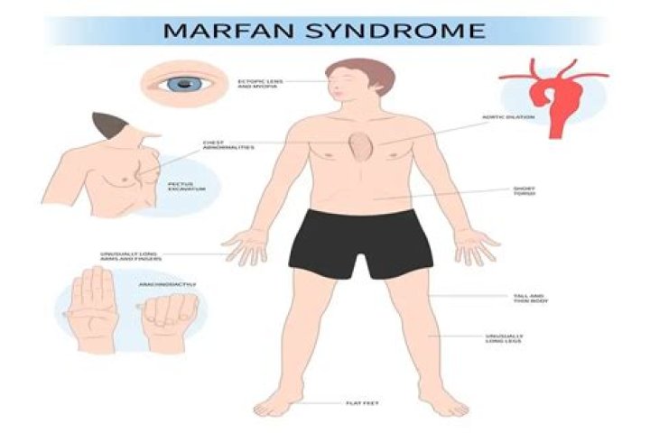 Zach Edey's Marfan Syndrome: Unraveling Discoveries And Insights